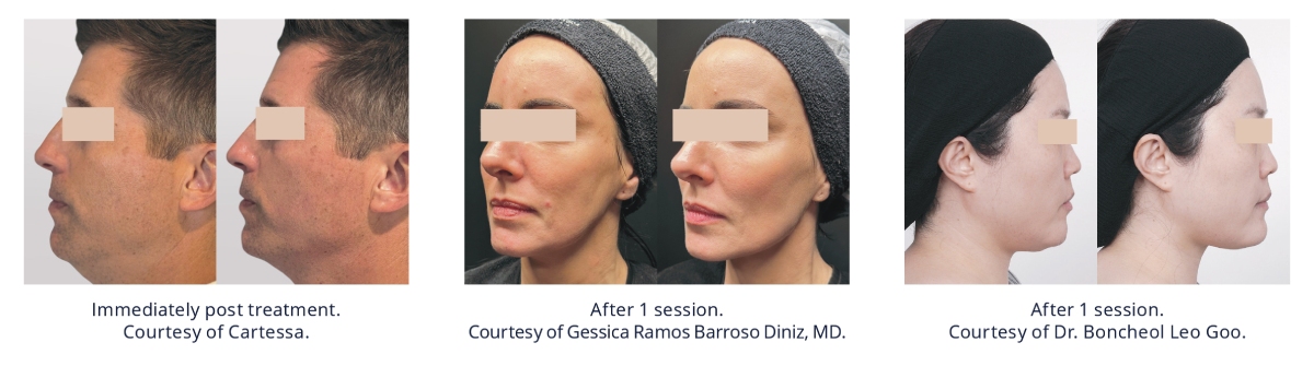 Skin Tightening and Lifting Kennett Square, PA