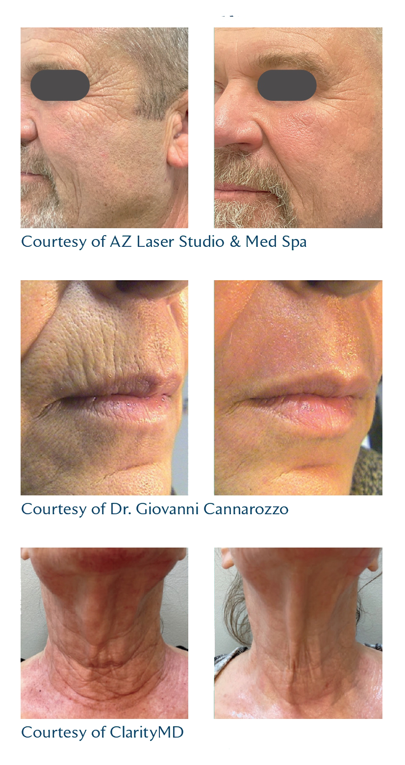 CO₂ Peel Kennett Square, PA