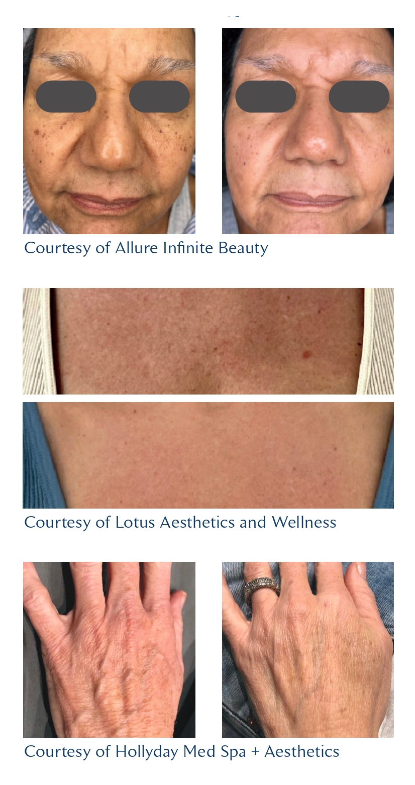 CO₂ Peel Kennett Square, PA